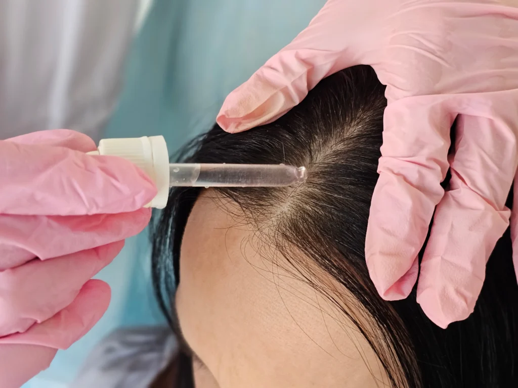 Practitioner applying a liquid treatment to the scalp with a dropper